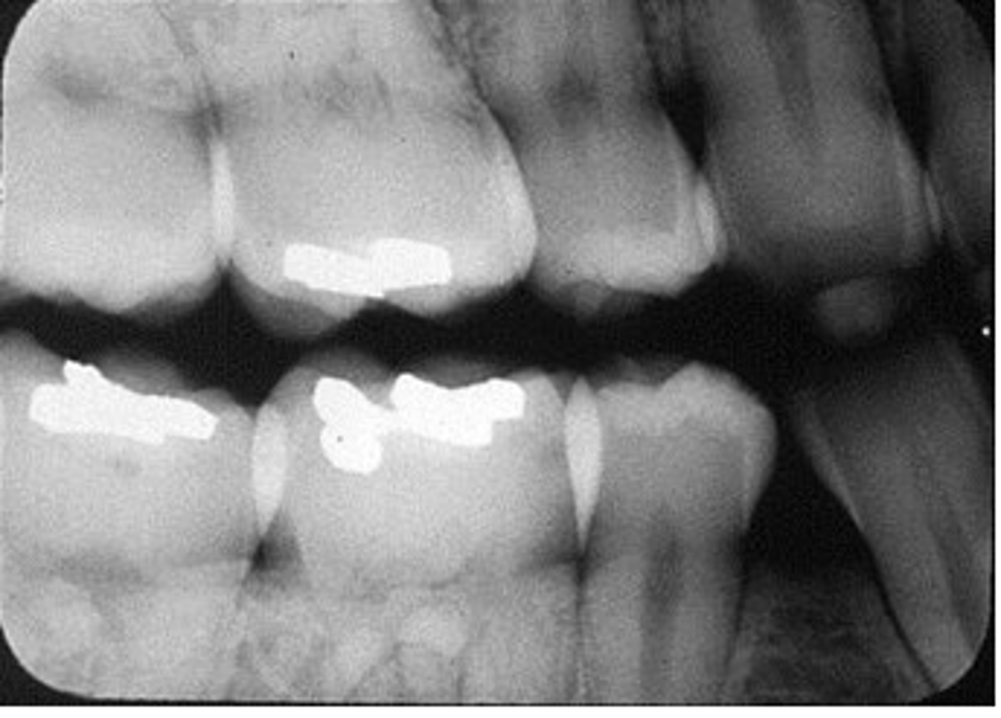 <p>crowns appear to be on top of each other</p>