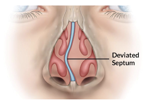 <ol><li><p>vaak aangeboren</p></li><li><p>zorgt voor belemmering ademhaling —> chirurgische ingreep</p></li></ol><p></p>