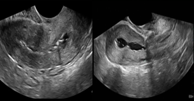 <p>_____ syndrome refers to <strong>intrauetrine adhesion</strong> of endometrial lining caused by C-section or D&amp;C</p><p>a) fitz hugh curtis</p><p>b) mirizzi</p><p>c) digeorge</p><p>d) asherman</p>