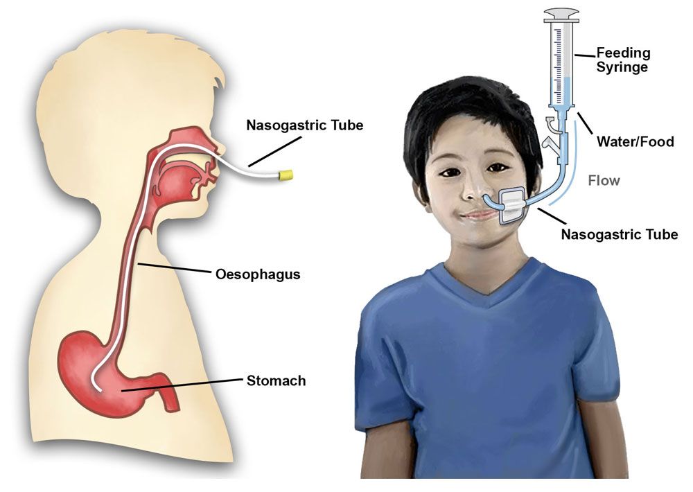 <p>naso-gastric tube</p>