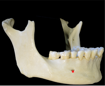 <p>Most inferior point on margin of the mandibular mental foramen</p>