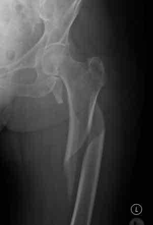 <p>Bone twisted apart due to rotational force</p>