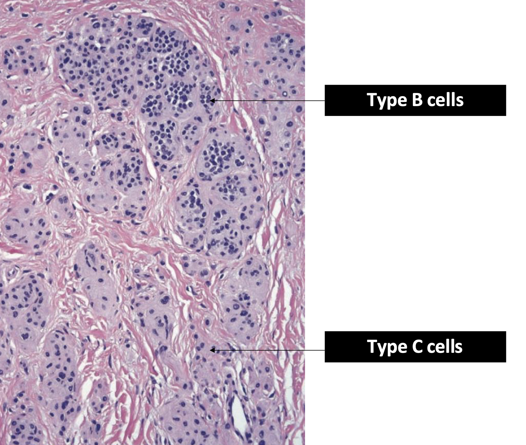 <p><span><span>Type B to Type C morphology is a key characteristic of benign nevi and a sign of normal cell maturation, which helps pathologists distinguish them from melanoma, where this organized maturation process is typically lost</span></span></p>