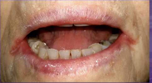 <p>what would be the management </p><p>mycelex troches </p><p>nystatin ointment </p><p>topical clobetasol </p><p>prednisone tablet </p>