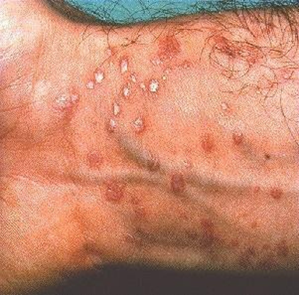 <p>lichen planus</p>