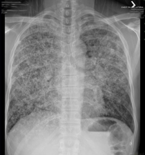 <p>CXR showing diffuse bilateral reticulonodular interstitial infiltrates. What is the most likely diagnosis?</p>