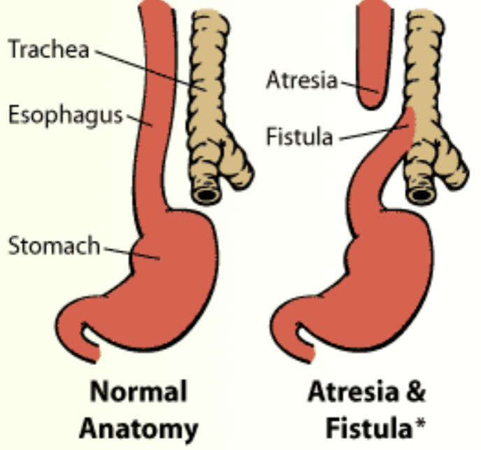 <ul><li><p>Polyhydramnios &amp; absent stomach</p></li><li><p>50% have fistula</p></li><li><p>50-70% have anorectal atresia</p></li><li><p>40% IUGR</p></li><li><p>Associated with <strong>Trisomy 18 </strong>and <strong>21</strong></p></li></ul><p></p>