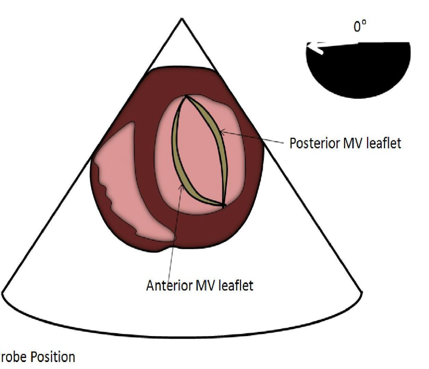 <p>TEE transgastric SAX basal taken at 0 degrees</p><ol><li><p>Posterior MV leaflet </p></li><li><p>Anterior MV leaflet </p></li></ol><p></p>