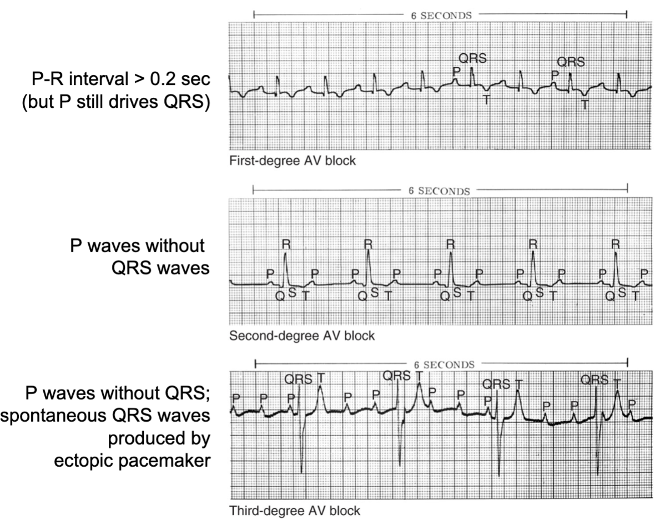 <p>Damage to the AV Node slows or blocks pacemaker signal from the atria. P-waves occur, sometimes without QRS-waves.</p>