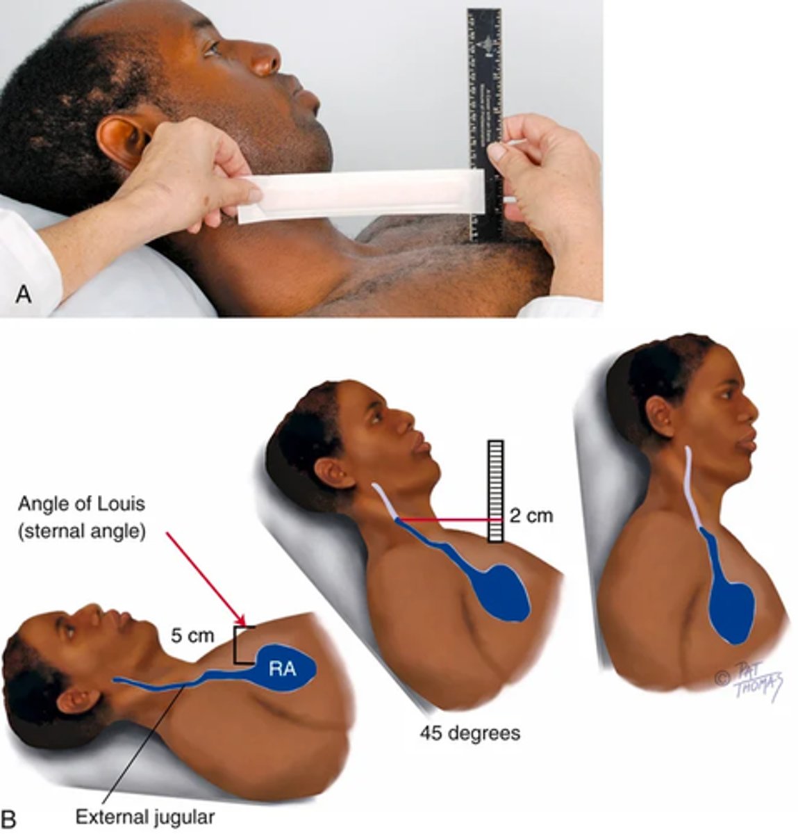 <p>Estimate the jugular venous pressure;</p><p>- Think of the jugular veins as a CVP manometer attached directly to the right atrium.</p><p>-You can "read" the CVP at the highest level of pulsations.</p><p>-Use the angle of Louis (sternal angle) as an arbitrary reference point, and compare it with the highest level of the distended vein or venous pulsation</p><p>Hold ruler on sternal angle -> align a straight edge on the rule like a T-square and adjust the level of the horizontal straight edge to the level of pulsation</p><p>(read the level of intersect on the vertical ruler; more accurate during expiration; a normal jugular venous pulsation is less than 3 cm above the sternal angle)</p><p>state the person's position (e.g., "internal jugular vein pulsations 2 cm above sternal angle when elevated 30 degrees").</p><p>try to estimate a CVP for the patient with ascites or edema; when elevated it suggest heart or lung disease; if normal the problem may be something like liver disease</p>