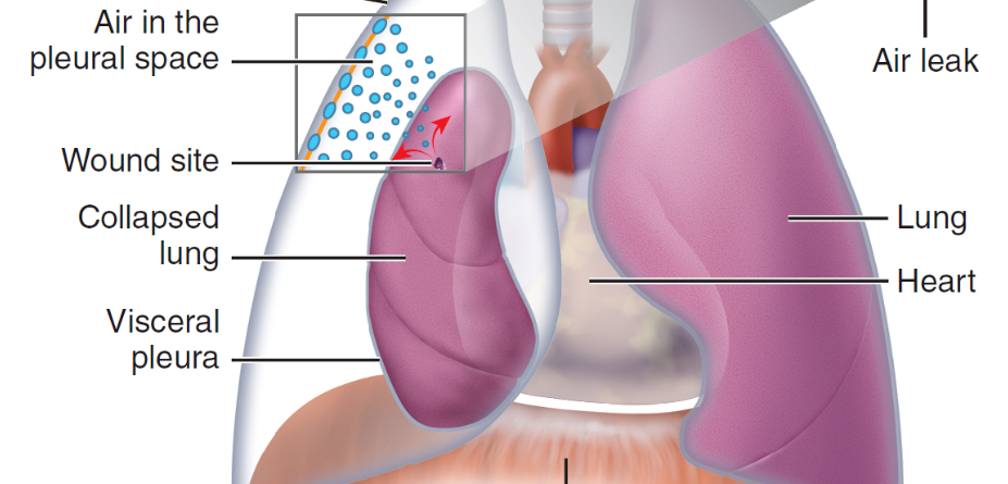 accumulation of air or gas in pleural cavity 