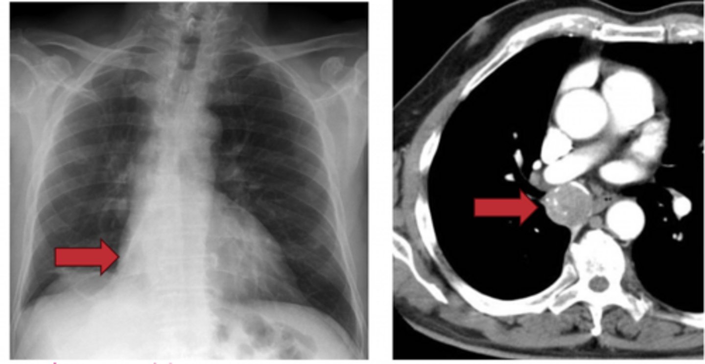 <p>A 35-year-old woman presents with a 1-year history of chronic cough, intermittent wheezing, and recurrent pneumonia localized to the right middle lobe. She is a non-smoker and reports that her symptoms have not improved with inhalers for presumed asthma.</p><p>Over the past 4 months, she has developed:</p><p>Weight gain with central obesity</p><p>Purple abdominal striae</p><p>Proximal muscle weakness</p><p>Easy bruising</p><p>Physical exam reveals mild unilateral wheezing over the right lung.</p>