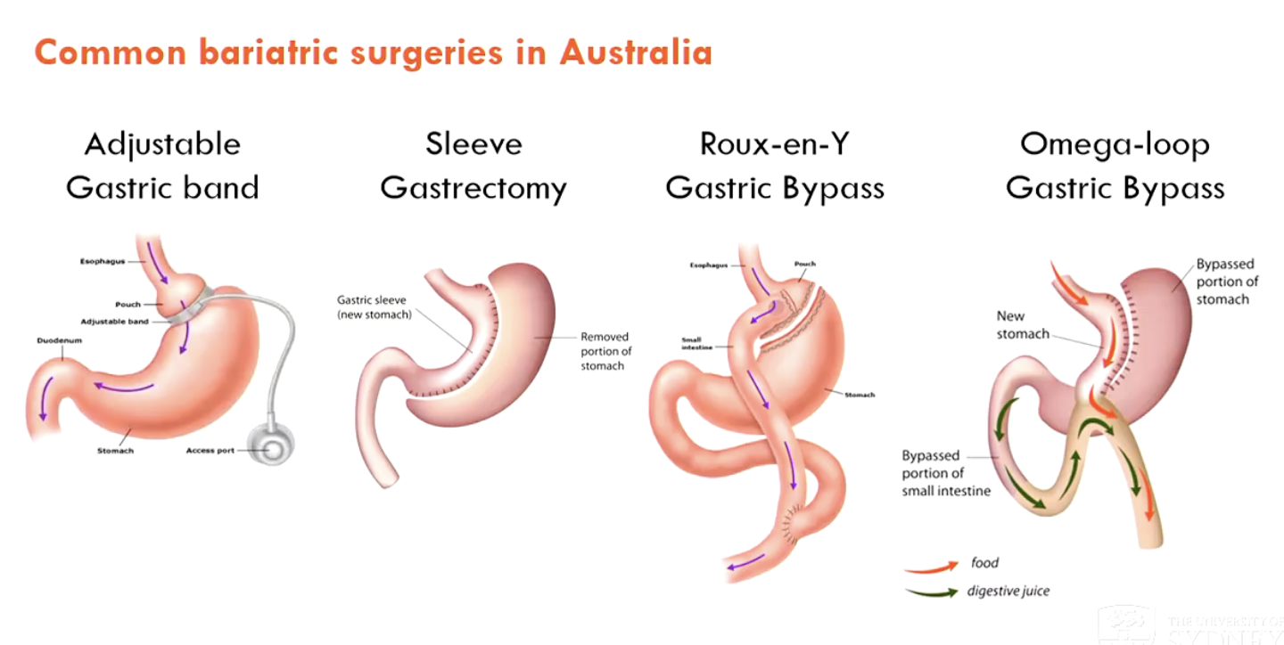 <ol><li><p>Adjustable gastric band (not preferred)</p></li><li><p>Sleeve gastrectomy (common in Aus)</p></li><li><p>Roux-en-Y gastric bypass</p></li><li><p>Omega-loop gastric bypass</p></li></ol><p></p>