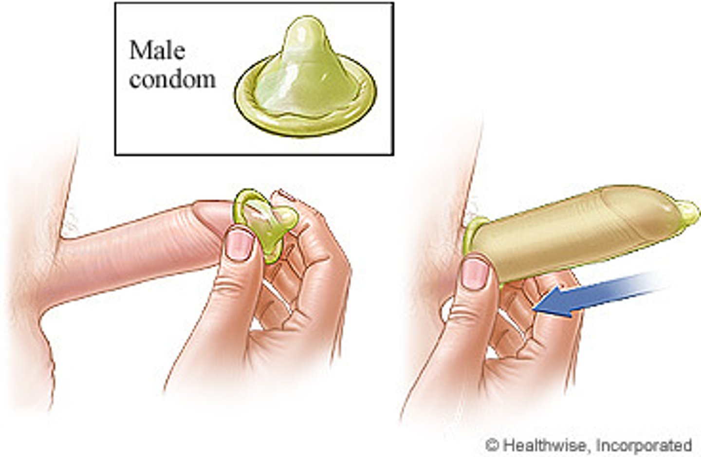 <p>covers the penis + keeps sperm out of the vagina + latex condoms (most common type) help protect against STI's and HIV + available OTC</p>