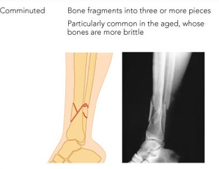 <p>bone is broken into 3 or more pieces. </p><ul><li><p>commonly found in old people who have brittle bone.</p></li><li><p>long and short bones are mostly affected </p></li></ul>