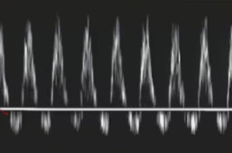 <p>A sonographer dopplered the umbilical artery and this doppler waveform was seen. </p><ol><li><p>Describe the waveform.</p></li><li><p>Based on the findings, would this be normal or abnormal?</p></li></ol><p></p>