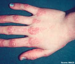 <p>What DM skin finding is being described?</p><ul><li><p>Erythematous/violaceous papules over bony prominences</p><ul><li><p>Dorsal aspect of MCP and IP joints most common</p></li></ul></li><li><p>Can scale and/or ulcerate</p></li></ul><p></p>