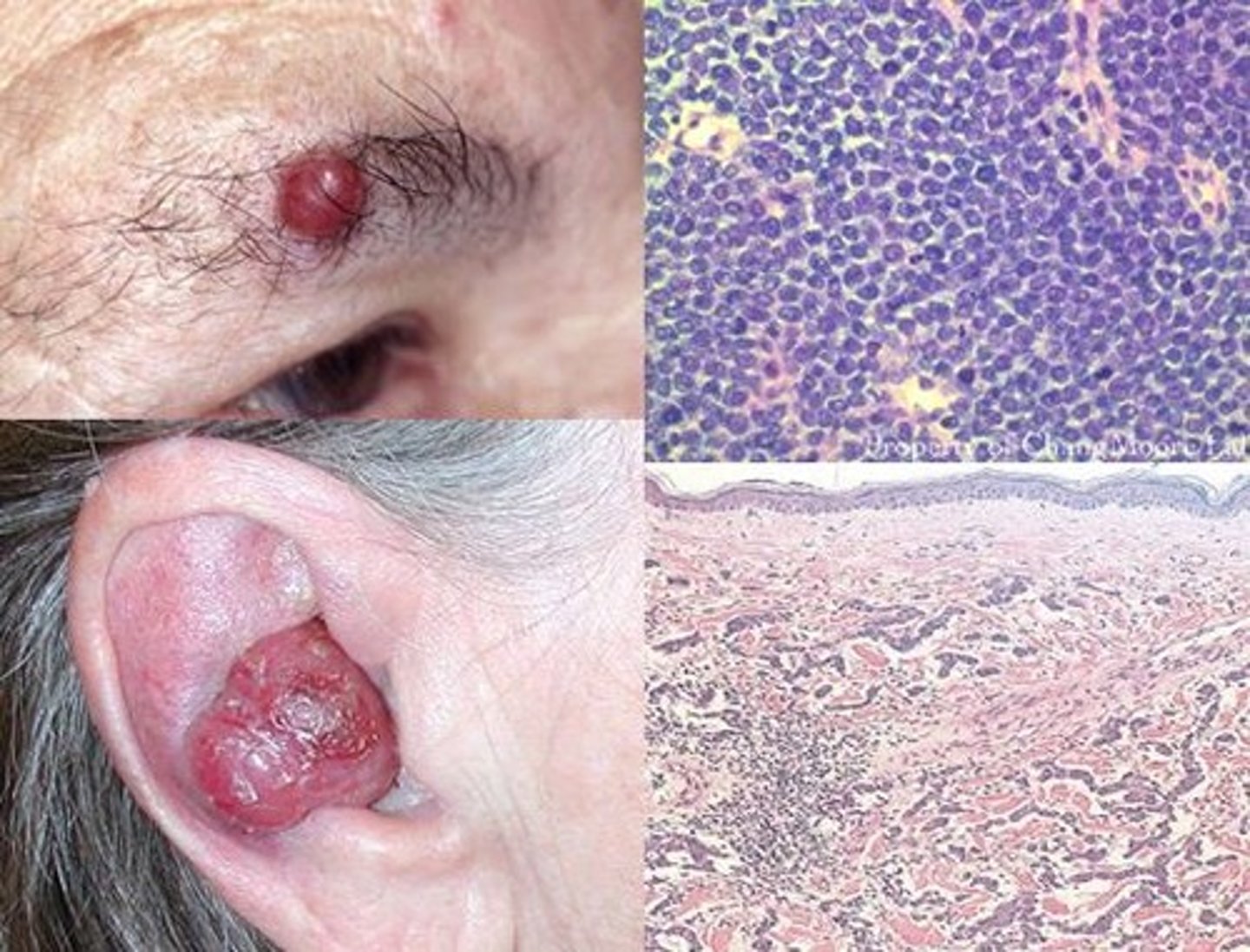 <p>Merkel Cell Carcinoma</p>