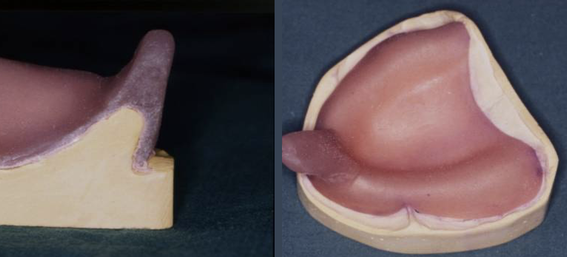 <p>outline a close fitting special tray </p>