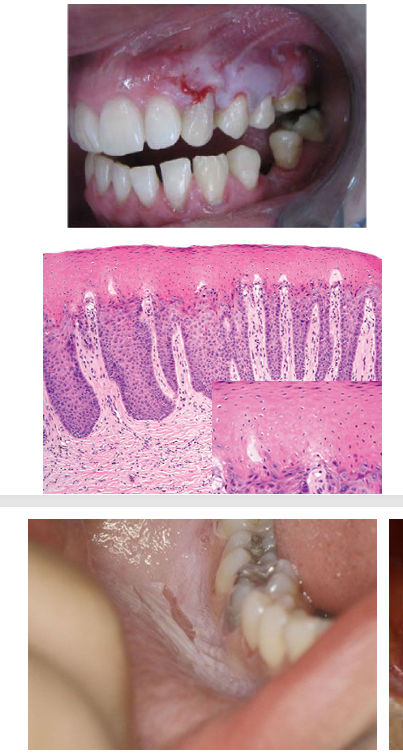 <p>-type of cell death causing denaturation of intracellular proteins</p><p>-denatured lysosomal enzymes cannot degrade injured/dying cell</p><p>-cell outline of injured/dying cell preserved</p>