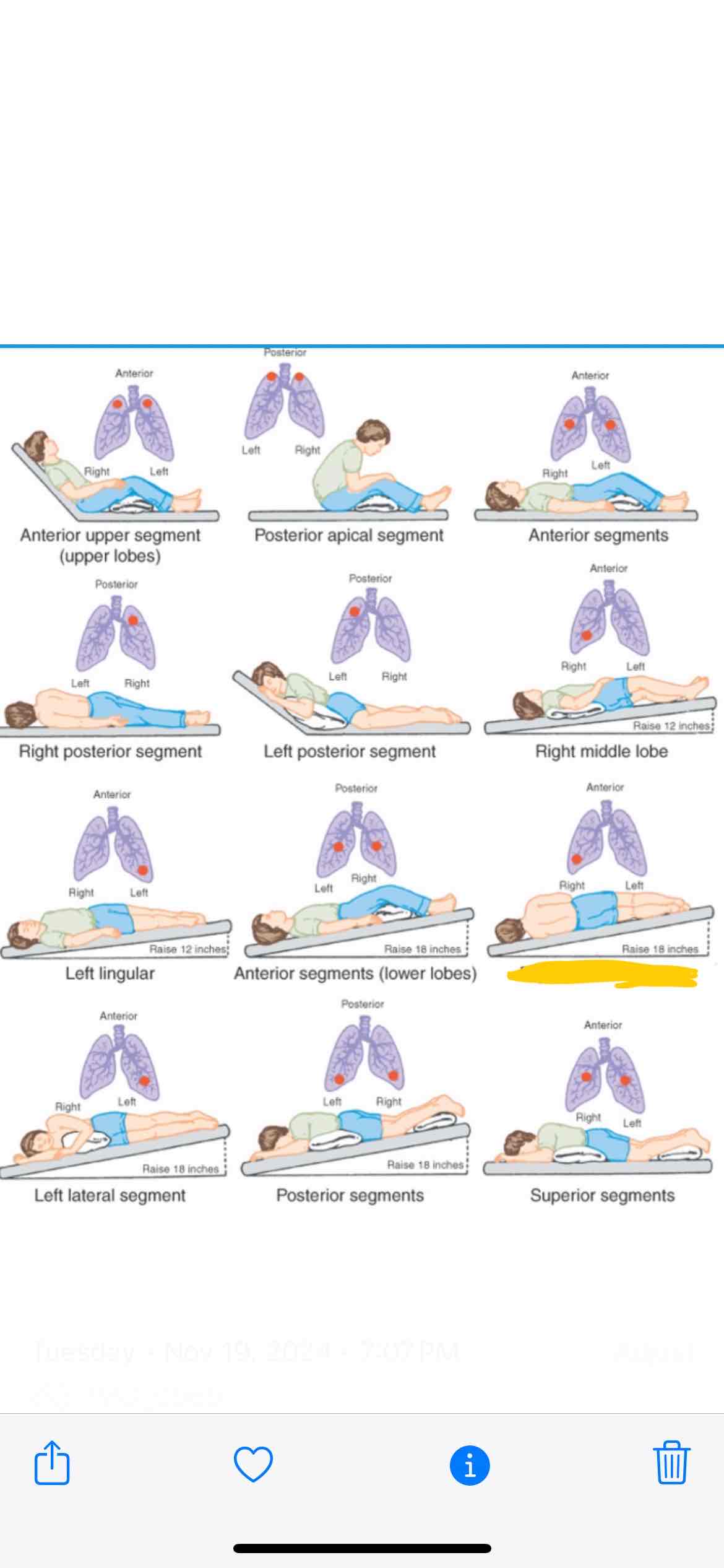 <p><span>Which lung segment does this position effect</span></p>