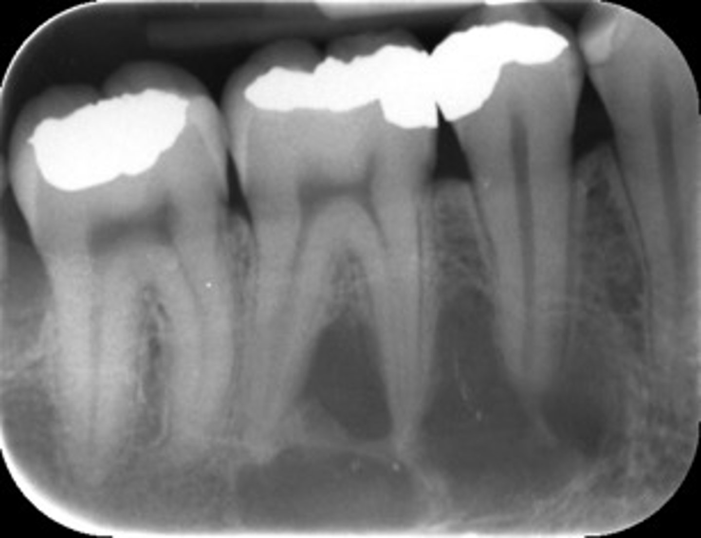 <p>ID the cyst:</p><p>•Radiolucent lesion</p><p>•Moderately to well-defined borders</p><p>•Unilocular or multilocular</p><p>•May create scalloping between roots of involved teeth</p><p>•Does not resorb or displace tooth roots</p>
