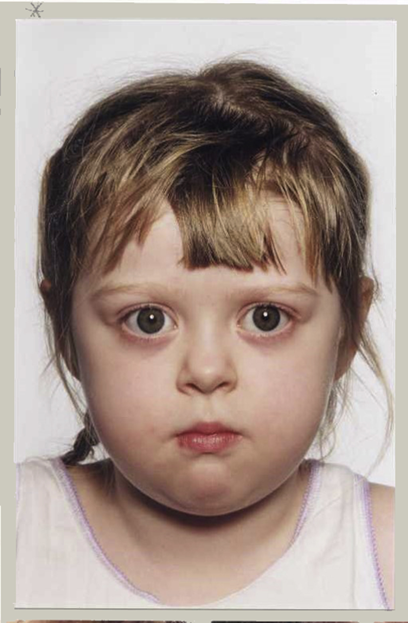 <p>Graves disease AKA diffuse toxic goiter</p>