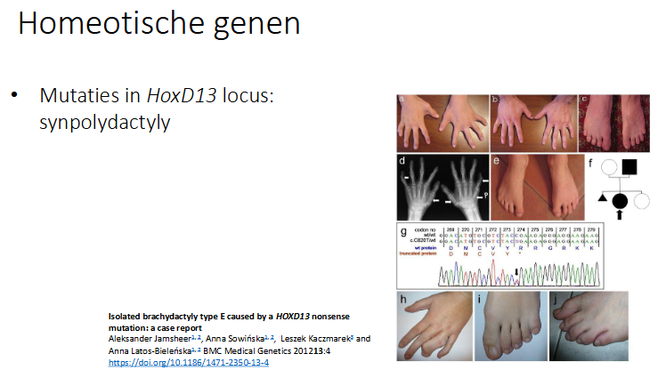 <p>synpolydactyly</p><p>tgv de mutatie in HoxD13 → vervroegd stopcodon → verkort eiwit → vingers en tenen bv ontwikkelen niet zoals normaal</p>
