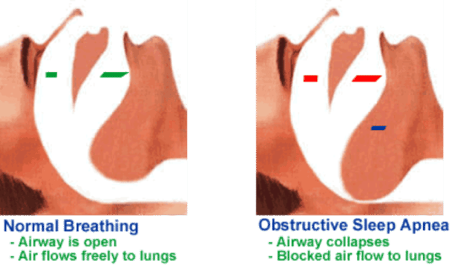 <p>- A sleep-related breathing disorder with apneic periods that last 10 seconds or more.</p><p>- defined by partial or complete collapse of the airway, interrupting ventilation and resulting in hypoxia and lack of sleep</p>