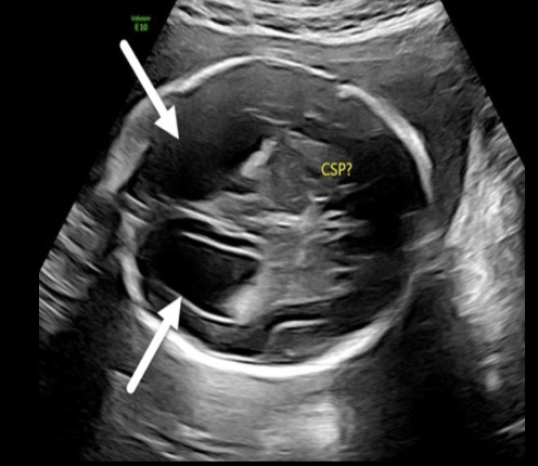 <p><strong>colpocephaly</strong> [dilation of posterior horns of lateral ventricle] is commonly assoc w/</p><p>.</p><p>a) hydranencephaly</p><p>b) alobar holoprosencephaly</p><p>c) agenesis of corpus callosum</p><p>d) acrania</p>