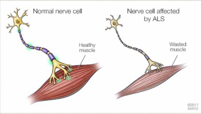 <p><span><strong>Also known as Lou Gehrig disease</strong></span></p><ul><li><p><span>Cellular death of motor neurons → progressive weakness &amp; atrophy of muscle fibers in extremities</span></p></li><li><p><span style="color: yellow"><strong>Cause unknown</strong></span><span>:</span></p><ul><li><p><span>Thought to be d/t overexcitation of nerve cells by glutamate → cell injury &amp; neuronal degeneration</span></p></li></ul></li><li><p><span style="color: yellow"><strong>Risk factors</strong></span><span>: age, autoimmune diseases, environmental exposure to toxins, family hx, smoking, viral infections</span></p><ul><li><p><span><strong>Onset age</strong>: 40-60 years old</span></p></li><li><p><span>Affects men a little more often than women</span></p></li><li><p><span>10% of cases are familial; onset occurs 10 years earlier than average</span></p></li></ul></li><li><p><span>Clinical presentation &amp; prognosis dependent on area of CNS involved &amp; speed of disease progression</span></p></li></ul><p></p>