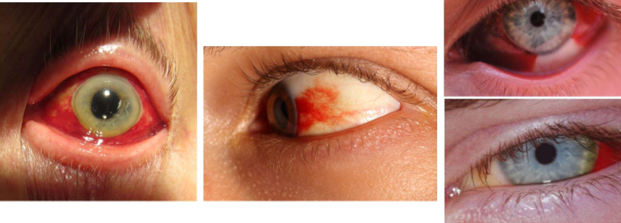 <ul><li><p>rupture of a posterior or anterior conj artery</p></li><li><p>typicall benign only require palliative treatment</p></li><li><p>associated with valsalva, blood thinners, constipation, straining</p></li></ul><p></p>