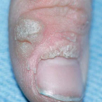 <p>flesh colored warts</p><p>by viruses</p><p>rough w/o scale</p>