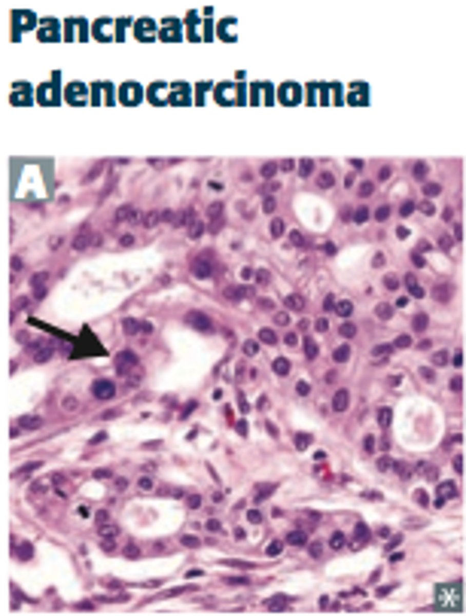 <p>Cancer of the pancreatic head obstructing the bile duct</p>