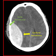 <p>Epidural Haematoma - arterial bleeding between the dura and the skull vault (associated with skull #) </p>