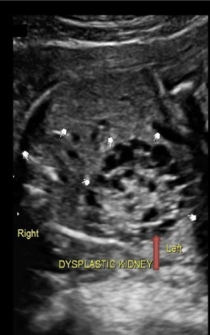 <p>what urinary anomaly is caused by urinary obstruction in the 1st trimester and leads to renal cyst formation + ureteral atresia</p><p>a) potter syndrome</p><p>b) multicystic kidney disease</p><p>c) infantile PCKD</p><p>d) adult PCKD</p>