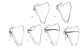 <ul><li><p>associated with high energy/trauma </p></li><li><p>other injuries to head, clavicle, spine, ribs&nbsp;</p></li><li><p>more commonly seen for chronic dislocation or separation&nbsp;</p></li><li><p>very rarely treated orthotically&nbsp;</p></li><li><p>immobilization and sling</p></li></ul><p></p>