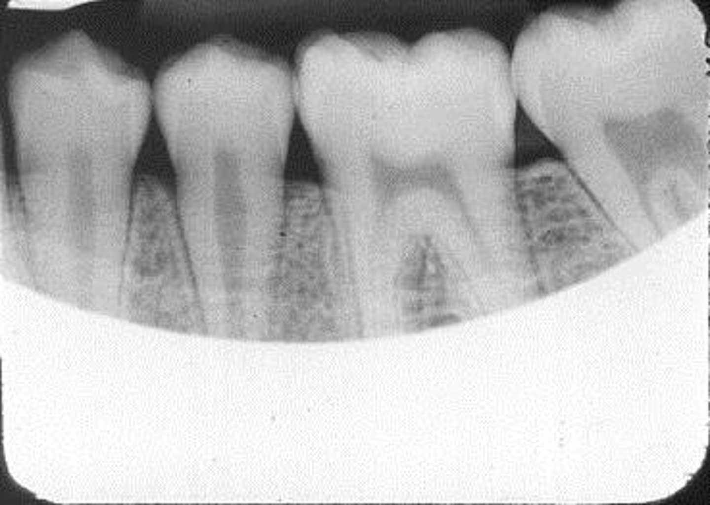 <p>Appearance-A clear area appears on the plate</p><p>Cause-BID was not properly aligned with the periapical plate holder or, incorrect setting of the RINN instrument</p><p>Correction-Make certain the x-ray beam is centered over the plate</p>