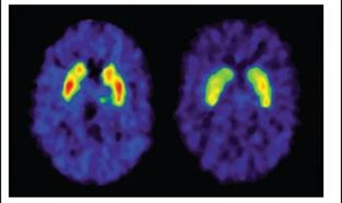 <p>Chronic drug use can lead to reduced D2 receptors in the striatum, as shown in PET scans.</p>