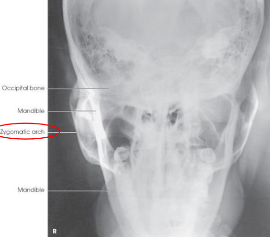 <ul><li><p>both zygomatic arches, free of superimposition</p></li><li><p>no overlap of arches by mandible</p></li><li><p>no rotation</p><ul><li><p>symmetric arches</p></li></ul></li><li><p>arches projected lateral to mandibular rami</p></li></ul><p></p>