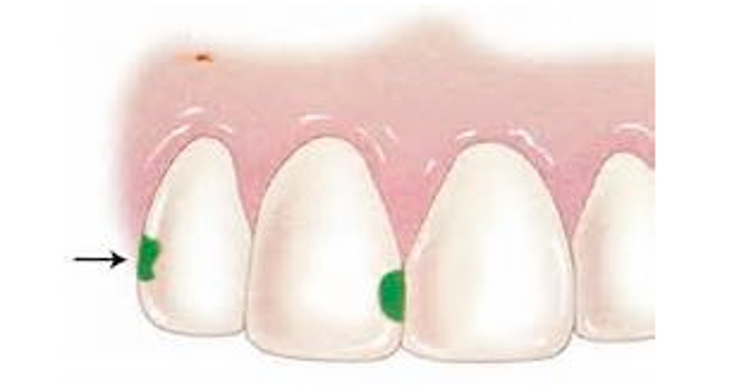 <p>the proximal surface of anterior teeth without incisal edge</p>
