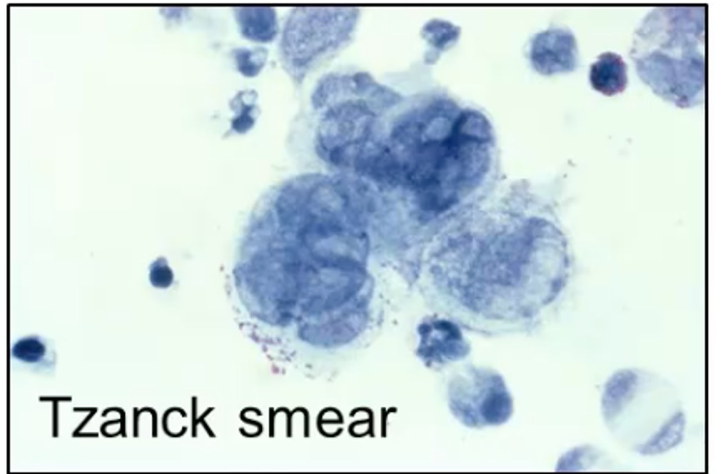 <p>Tzanck smear</p>