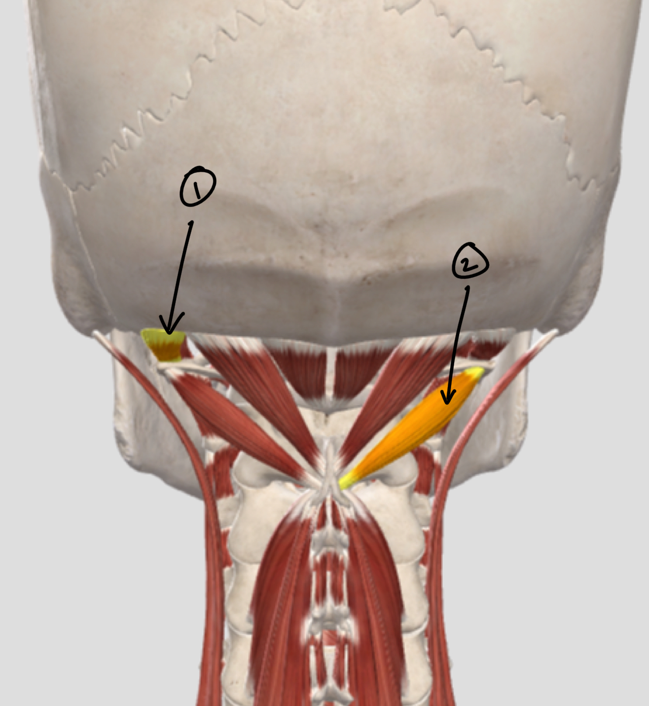 <p>What mm are these?</p><p>O, I, A bilateral and unilateral, N</p>