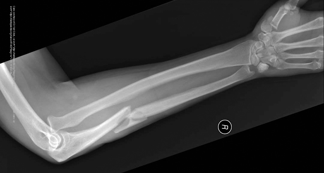 <p>Ulnar shaft fracture with anterior dislocation of the radial head.</p>