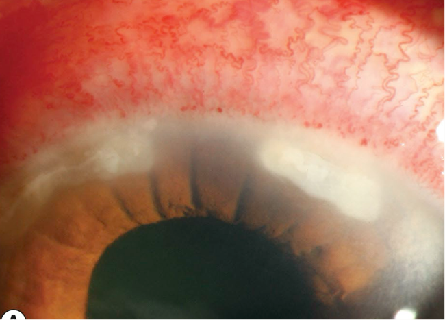 <ul><li><p>inflammatory cells, cellular debris, and tissue necrosis located in the anterior stroma</p></li><li><p>appear white to grey</p></li><li><p>conj. hyperemia will also be present</p></li></ul><p></p>