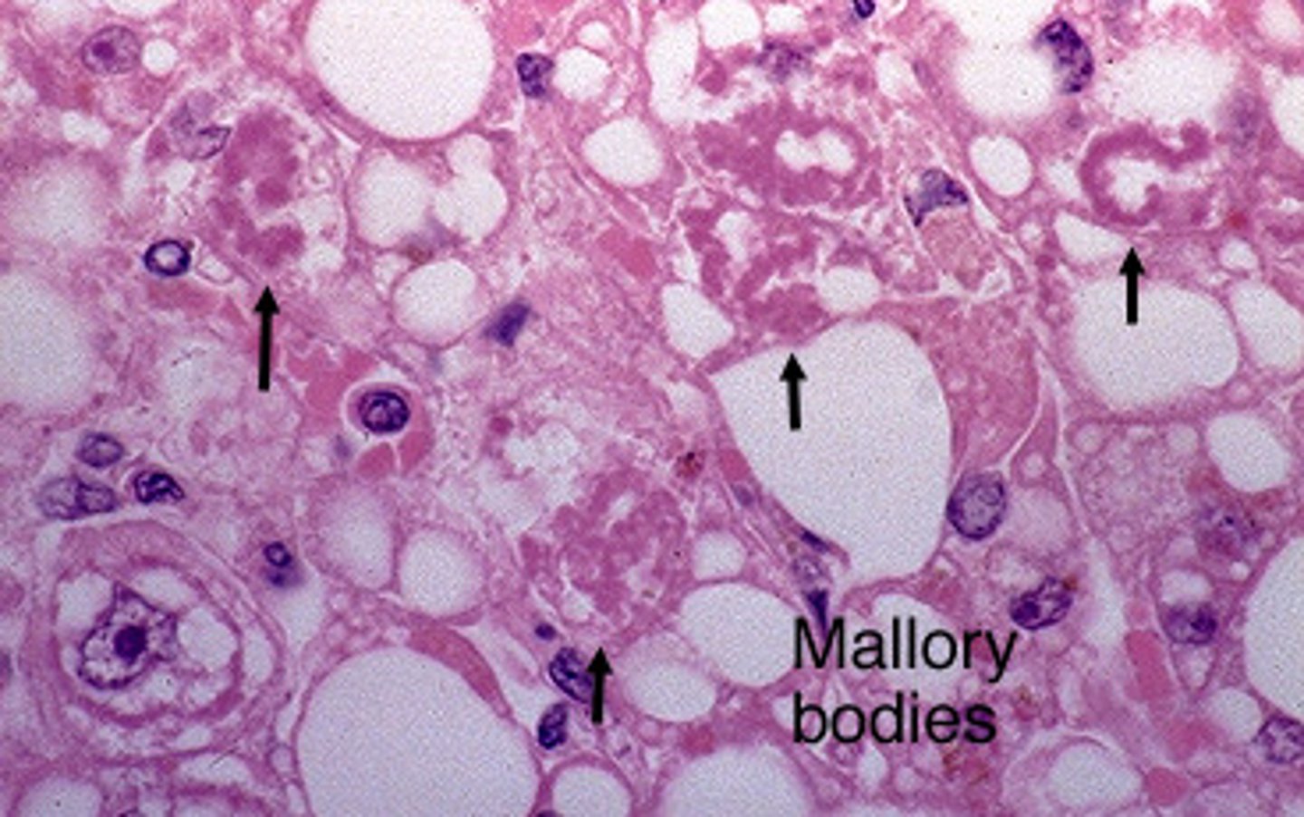 <p>mallory bodies = Alcohol (Fun)</p>