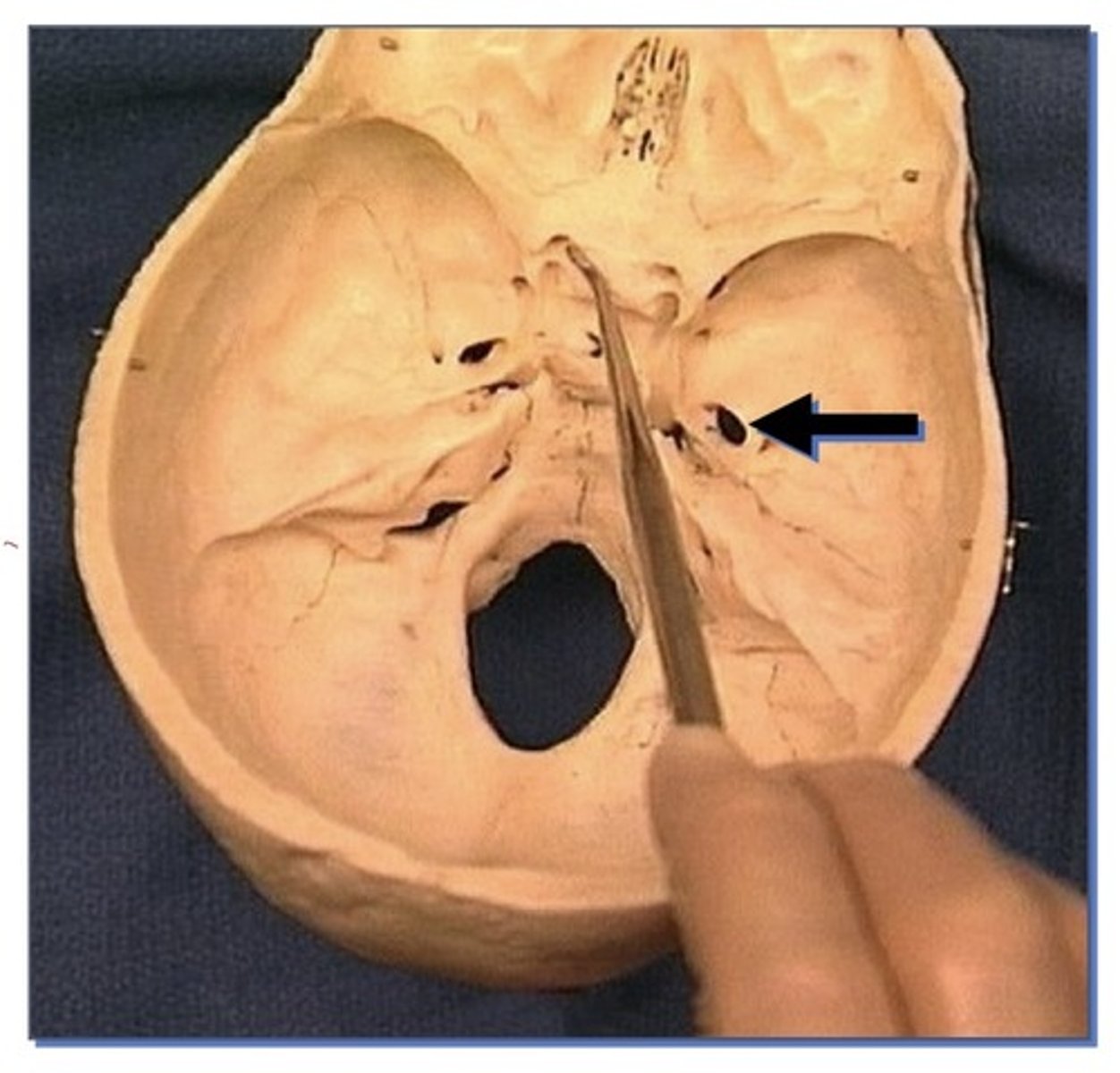 <p>1. Larger, oval opening</p><p>2. Posterior aspect of Sphenoid bone</p>