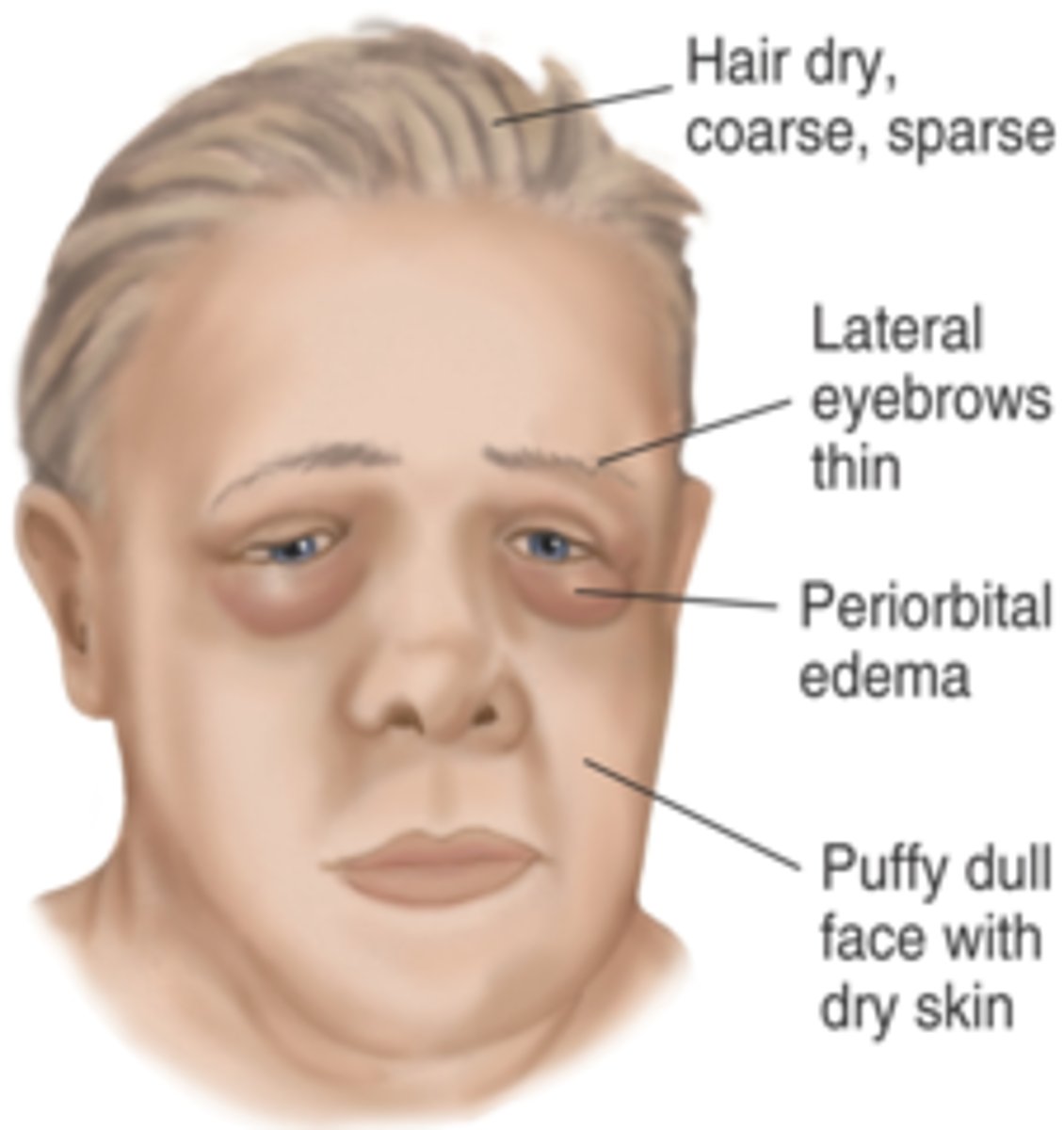 <p>caused by extreme deficiency of thyroid secretion; also known as adult hypothyroidism; if lack of iodine then goiter can develop (enlargement on neck). happens as negative feedback when TSH is over secreted as a response to low TH levels. symptoms include low metabolic rate, thick and dry skin, puffy eyes and chills, constipation, edema, sluggishness, lethargy</p>