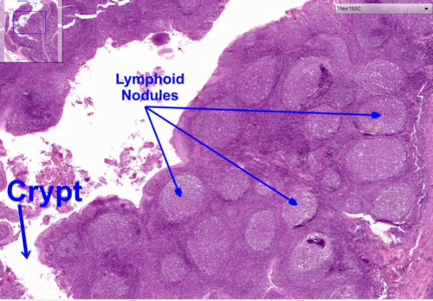 <p>unencapsulated patches of lymphoid tissue found throughout the body</p>