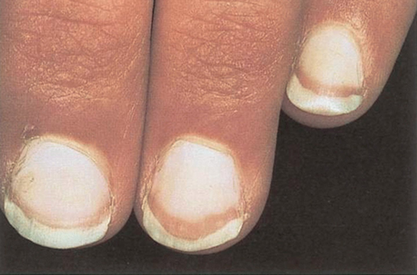 <p>-terry's nails</p><p>-liver disease, heart failure, diabetes</p>